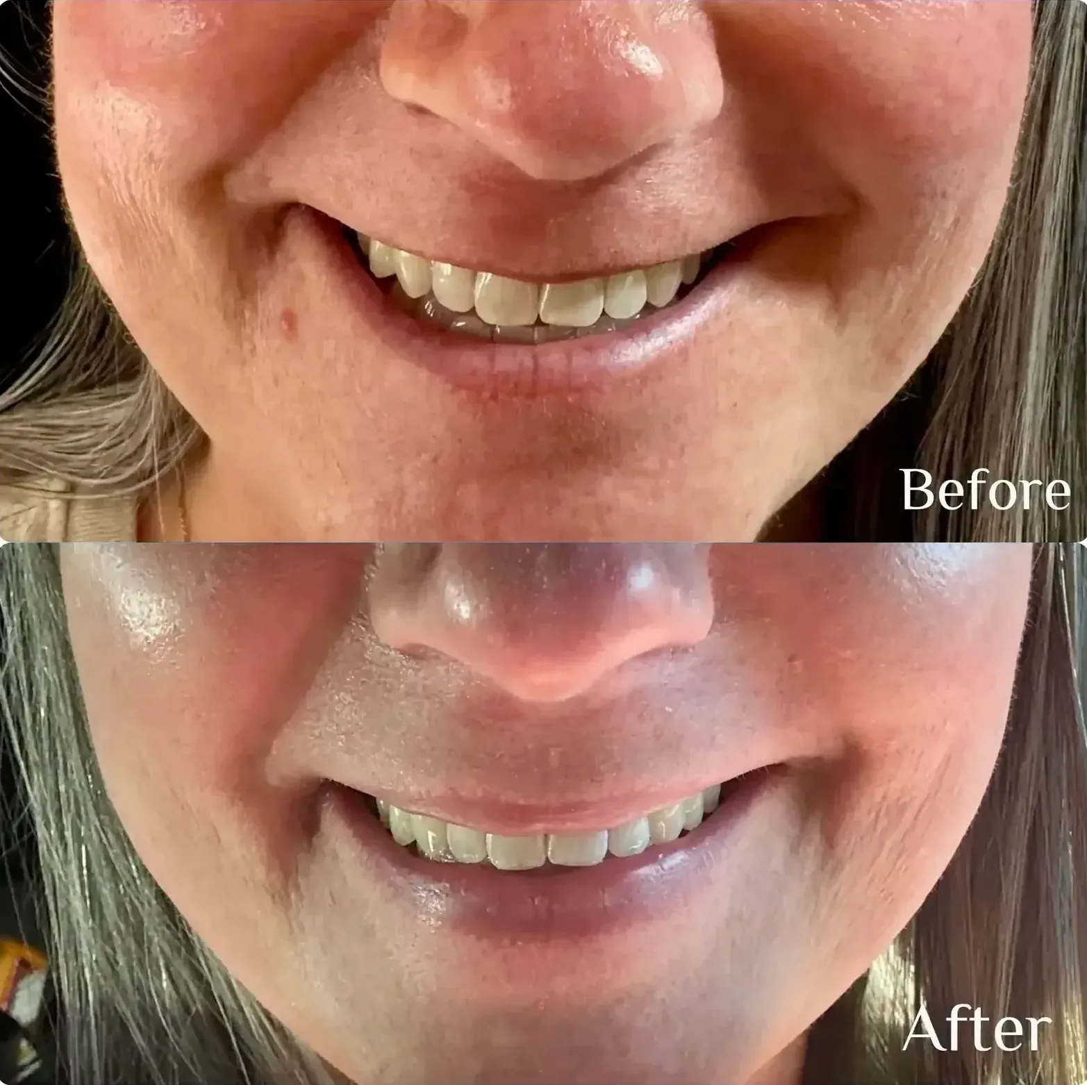 Before After Daxxify Lip Flip