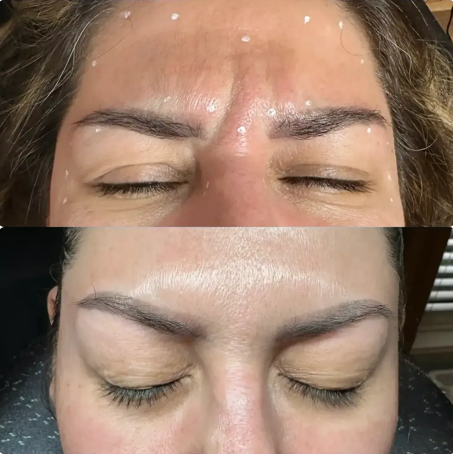 Before After Dysport