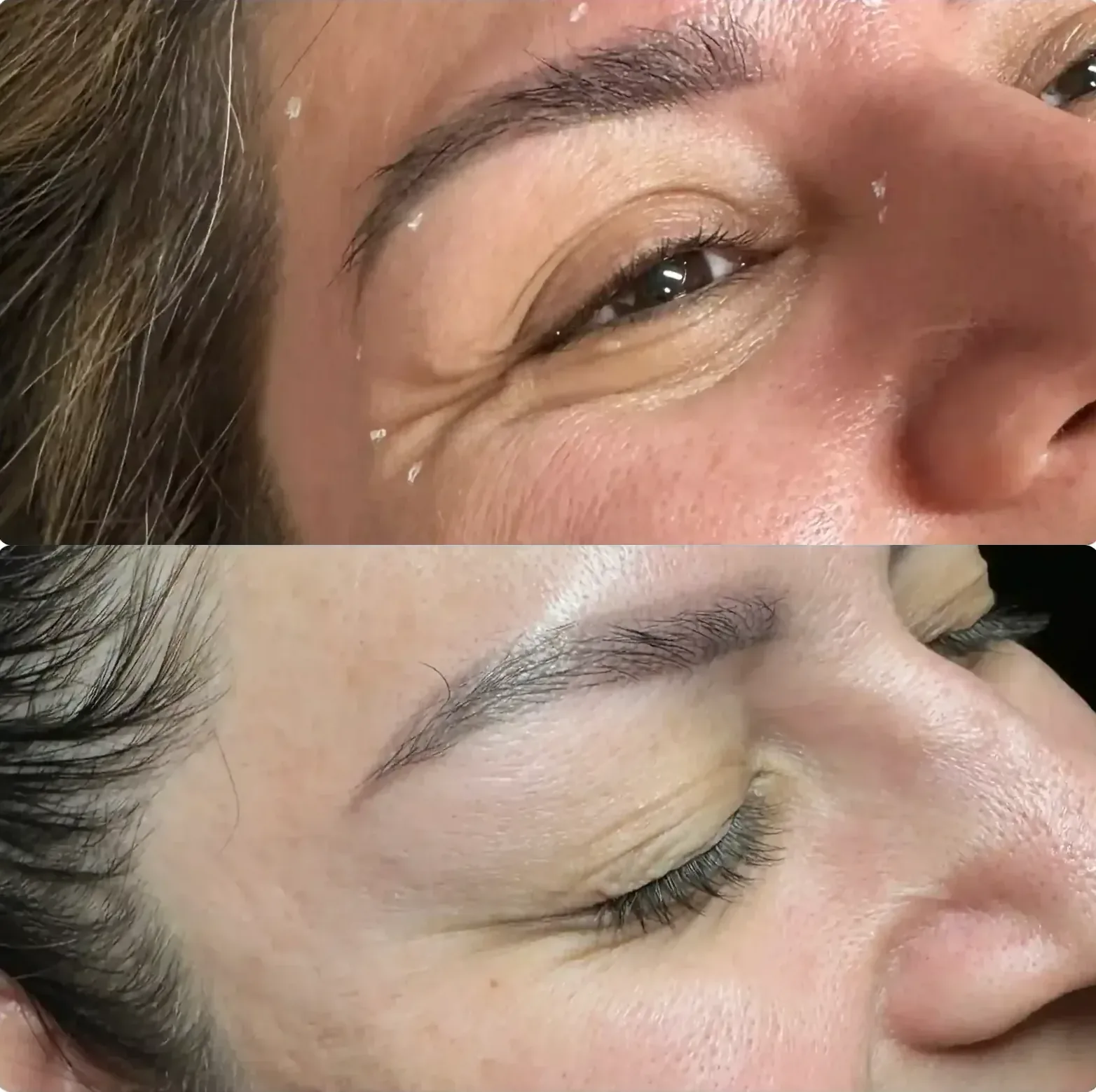 Before After Dysport Crow's Feet