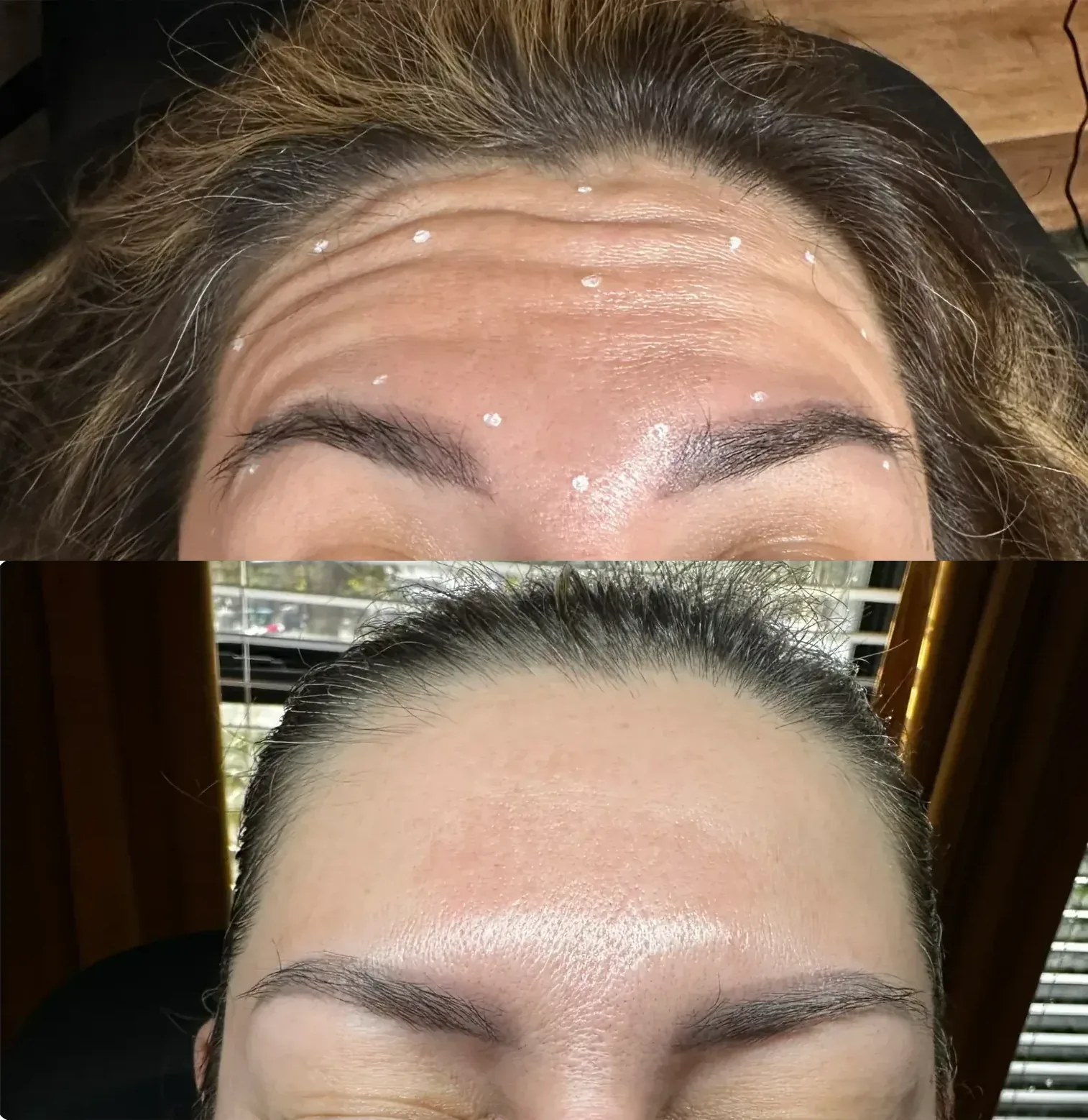 Before After Dysport Forehead