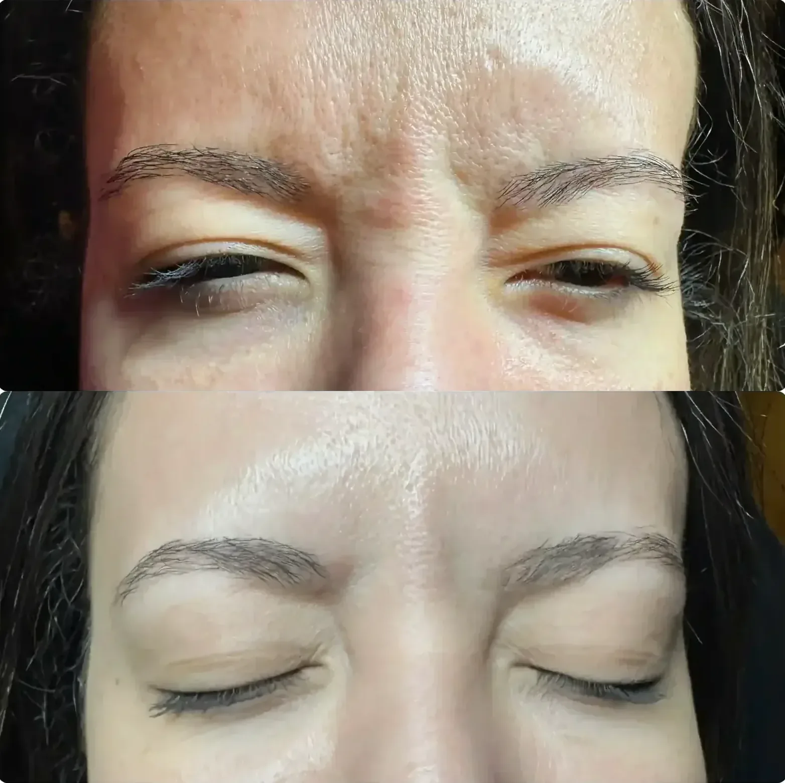 Before After Letybo treatment