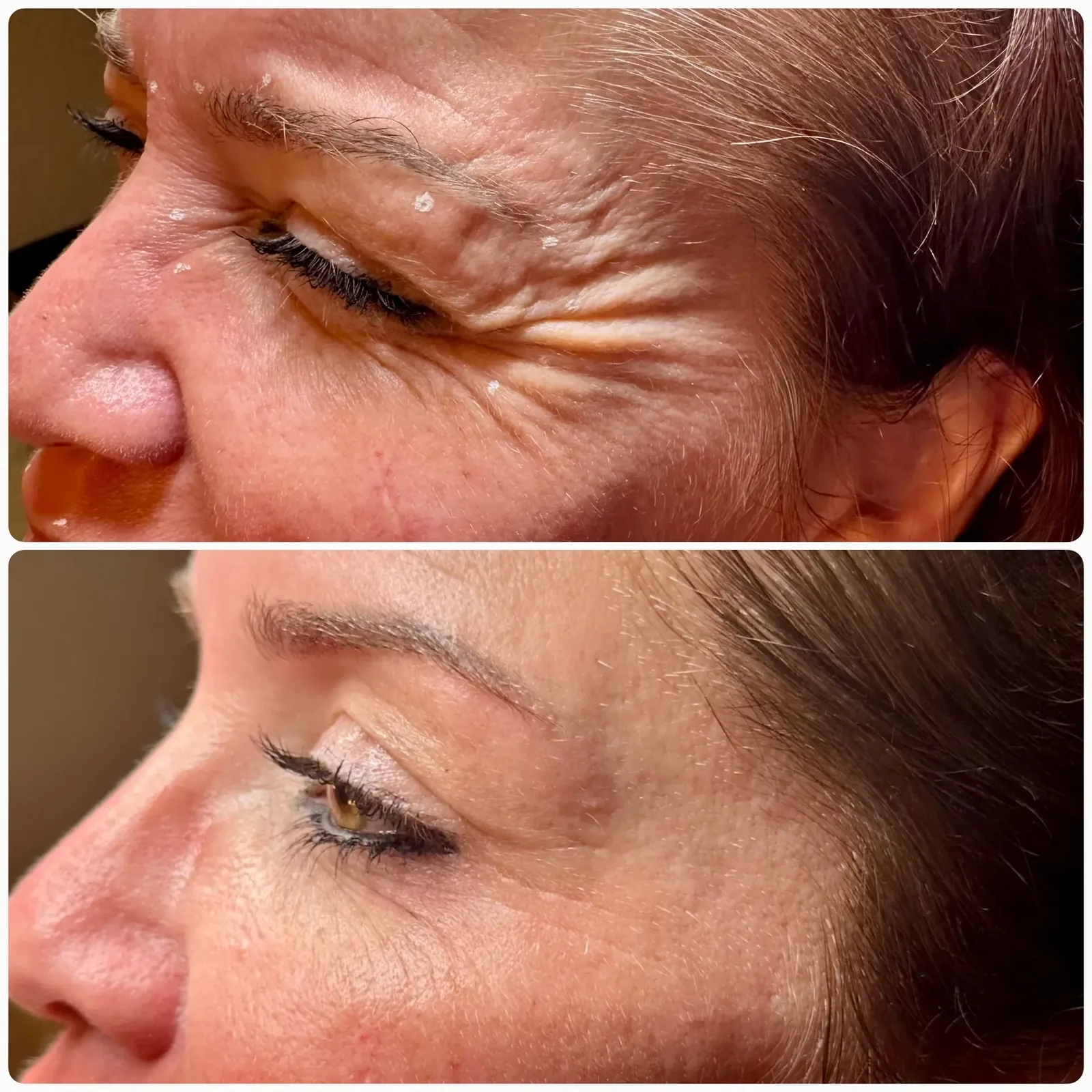 Botox for crow's feet in Leander TX