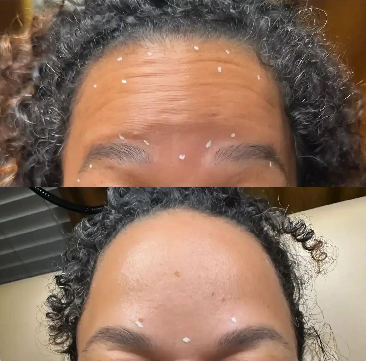 Before After Letybo Forehead