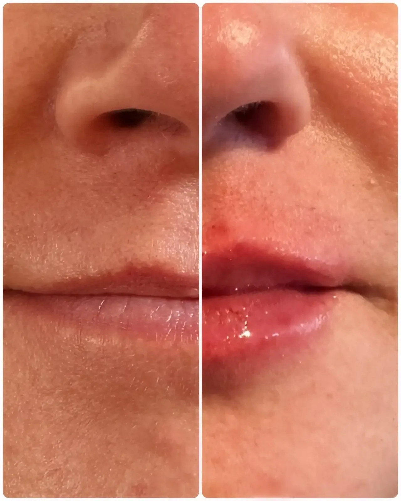 Lip filler results in Leander TX