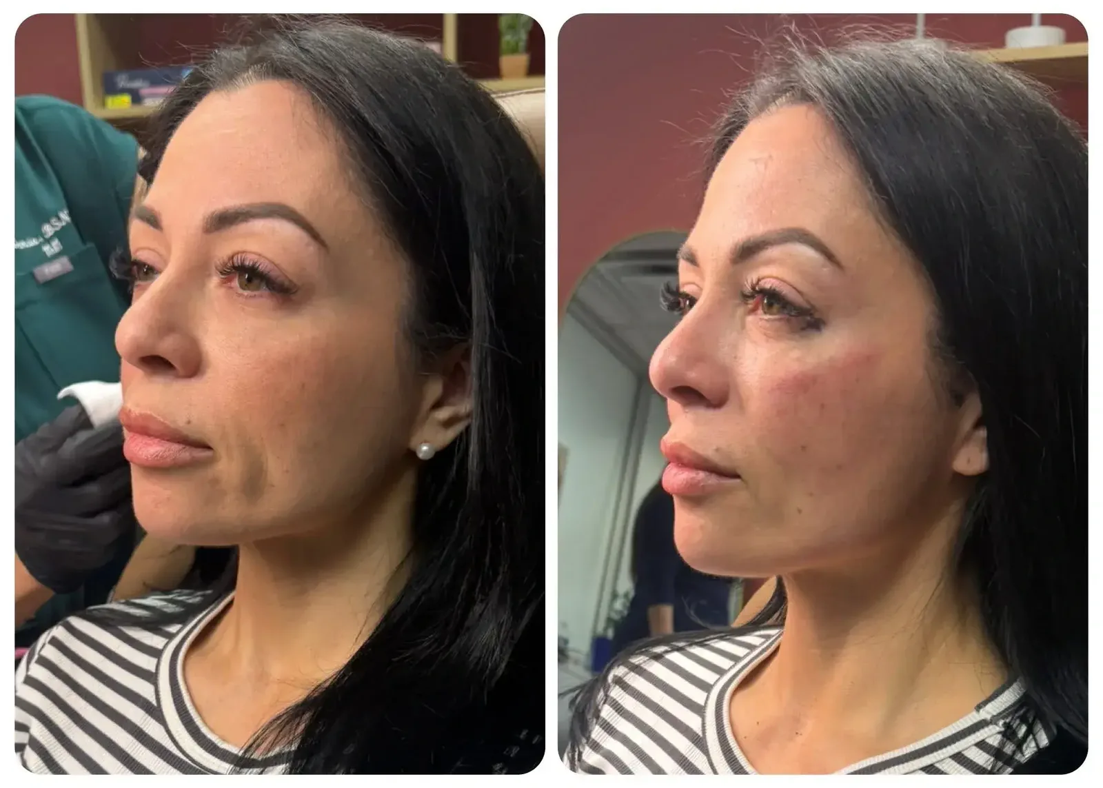 Facial balancing with filler in Georgetown TX