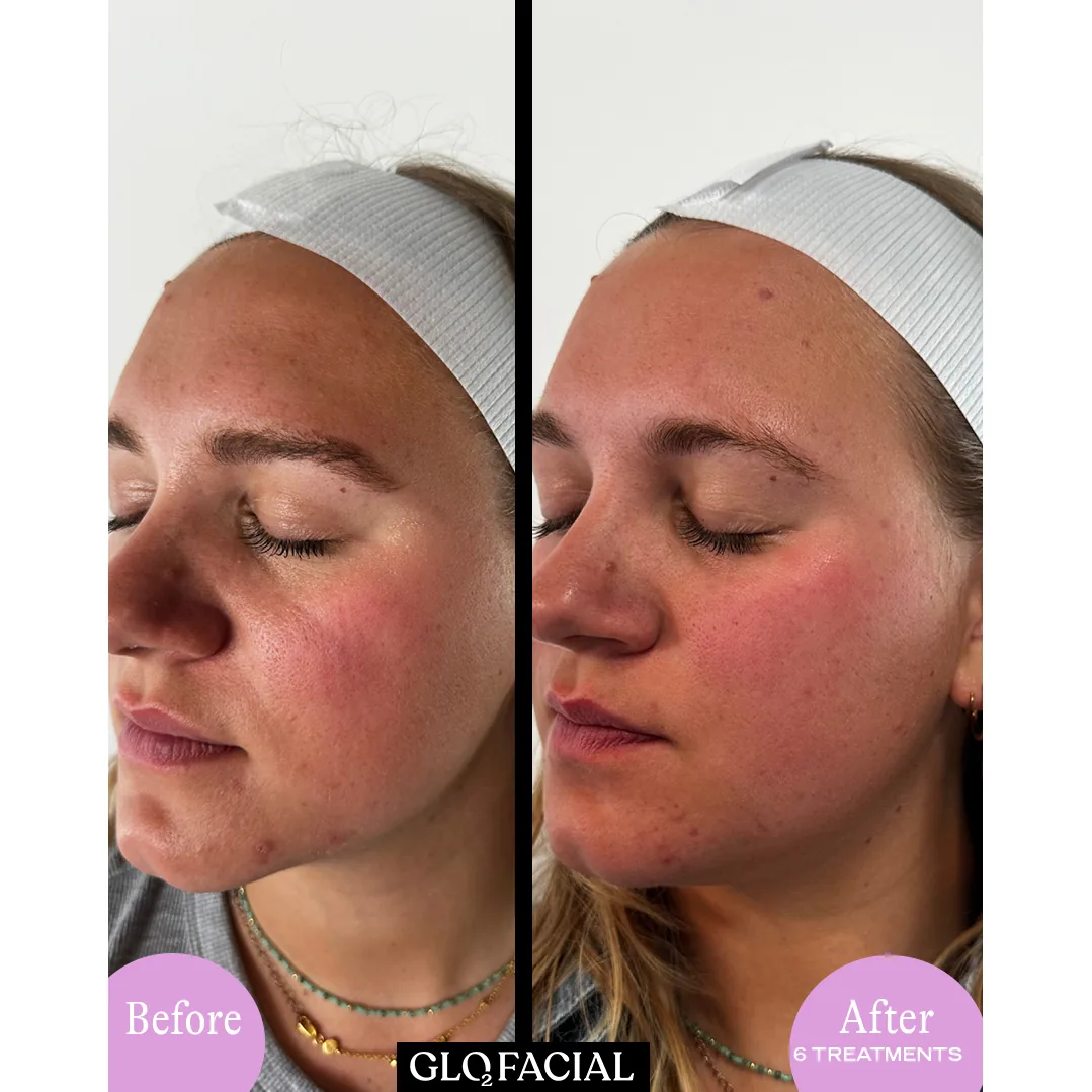 Glo2Facial before and after: refined texture and tone after six treatments