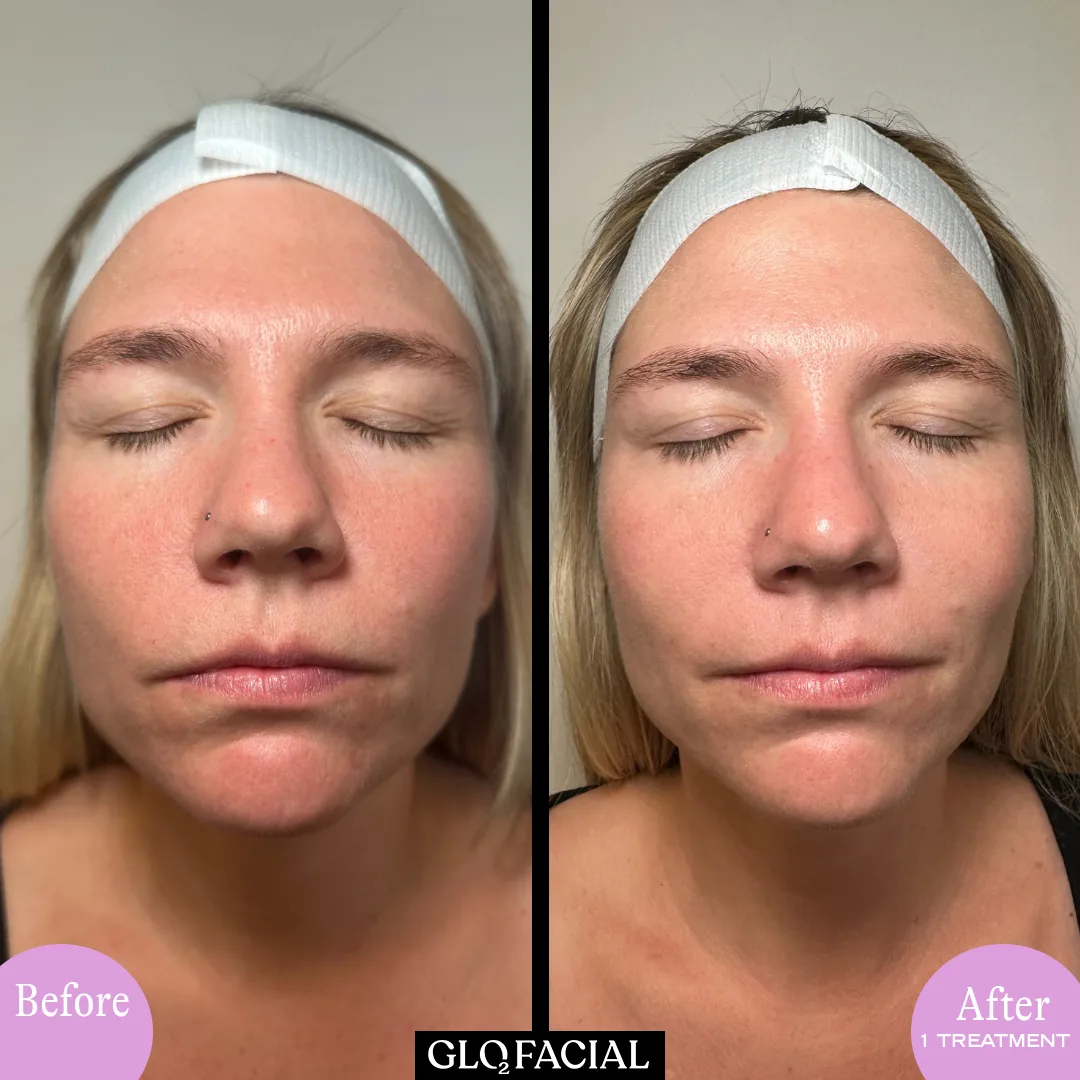 Glo2Facial before and after: calmer, brighter skin after one oxygen facial treatment