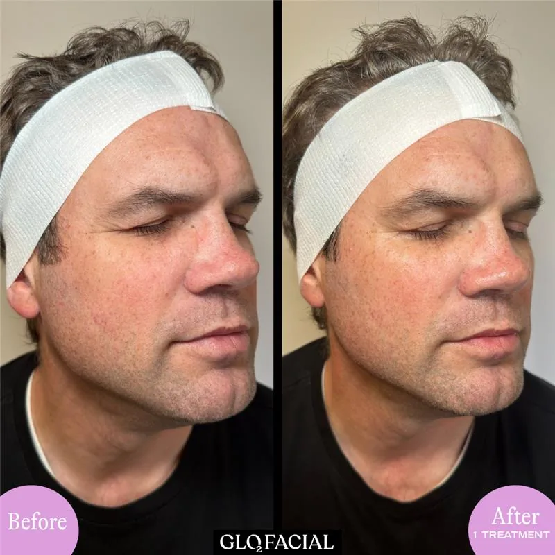 Glo2Facial before and after on a male client: smoother, more even skin after one treatment